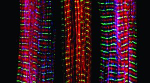 Three muscle fibers; the middle has a defect found in some neuromuscular diseases Of the three muscle fibers shown here, the one on the right and the one on the left are normal. The middle fiber is deficient a large protein called nebulin (blue). Nebulin plays a number of roles in the structure and function of muscles, and its absence is associated with certain neuromuscular disorders. Credit: Christopher Pappas and Carol Gregorio, University of Arizona via Flickr.